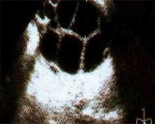 什么是试管婴儿降调