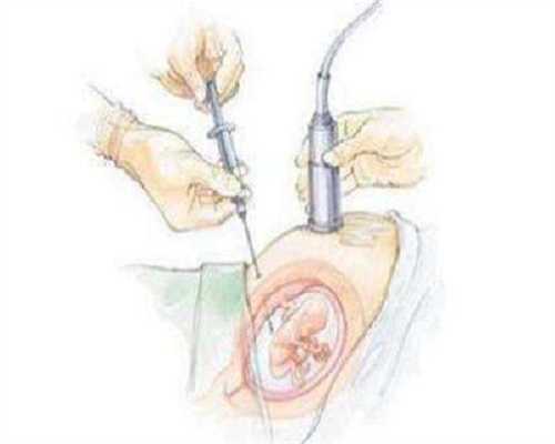 江苏六院供卵试管成功率